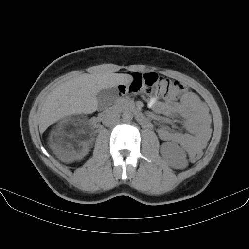 Adrenal myelolipoma - bilateral (Radiopaedia 74805-85810 Axial non-contrast 34).jpg