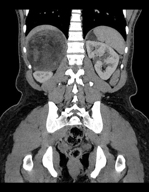 Adrenal myelolipoma - bilateral (Radiopaedia 74805-85810 Coronal C+ portal venous phase 104).jpg