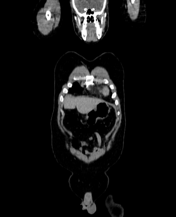 Adrenocortical carcinoma (Radiopaedia 80134-93438 Coronal C+ portal venous phase 28).jpg