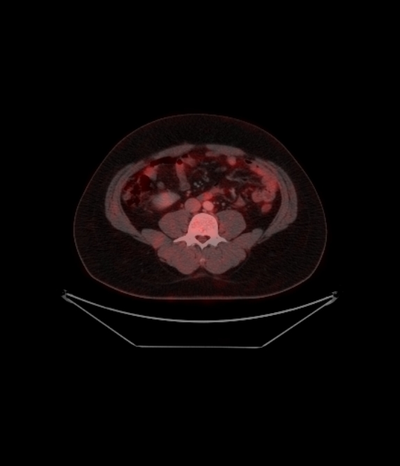 Adrenocortical carcinoma (Radiopaedia 80134-93440 ِAxial 199).jpg