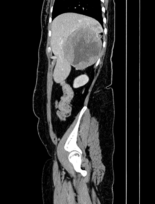 Adrenocortical carcinoma (Radiopaedia 87281-103569 Sagittal C+ portal venous phase 45).jpg