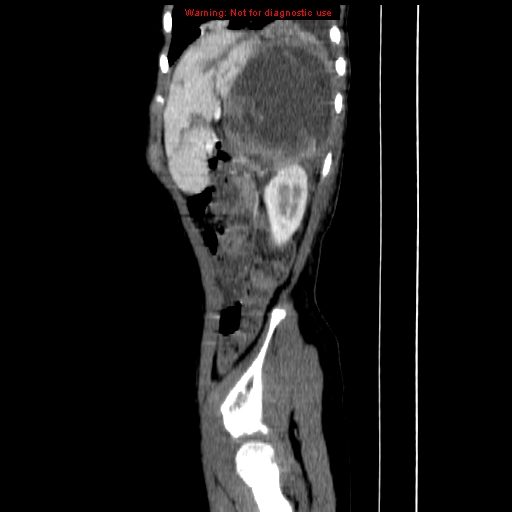 File:Adrenocortical carcinoma (Radiopaedia 9449-10131 Sagittal C+ portal venous phase 17).jpg