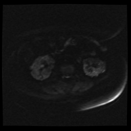 Adult polycystic kidney disease (Radiopaedia 59075-66365 Axial DWI 42).jpg