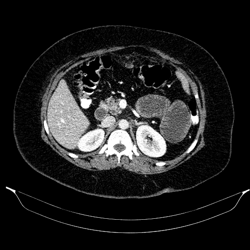 Afferent loop syndrome - secondary to incarcerated trocar site hernia (Radiopaedia 82959-97305 Axial C+ portal venous phase 84).jpg