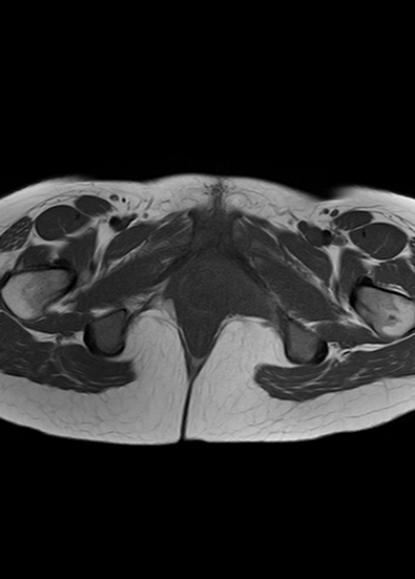 File:Aggressive angiomyxoma of the pelvis and perineum (Radiopaedia 59162-66479 T1 5).jpg