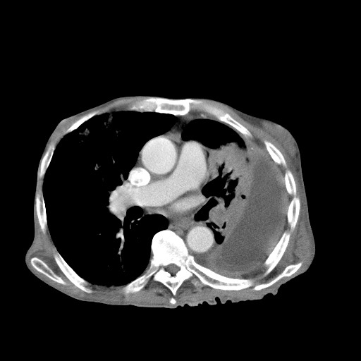 File:Aggressive lung cancer with cardiac metastases, pulmonary artery tumor thrombus, and Budd-Chiari (Radiopaedia 60320-67981 A 29).jpg