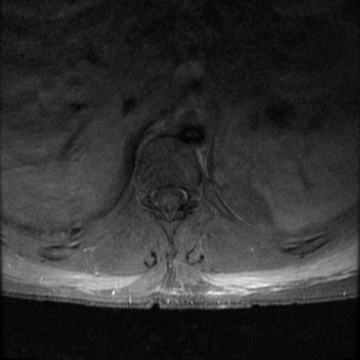 File:Aggressive vertebral hemangioma (Radiopaedia 39937-42404 Axial T1 C+ fat sat 10).png