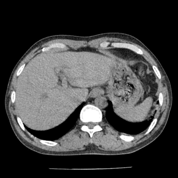 Airway foreign body in adult (Radiopaedia 85907-101779 Axial liver window 184).jpg