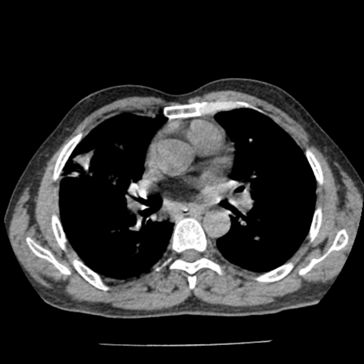 Airway foreign body in adult (Radiopaedia 85907-101779 Axial liver window 83).jpg