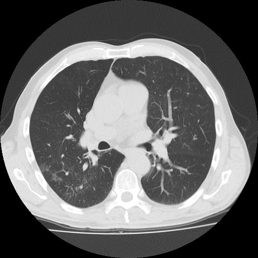 Allergic bronchopulmonary aspergillosis (ABPA) (Radiopaedia 60594-68313 Axial lung window 29).jpg
