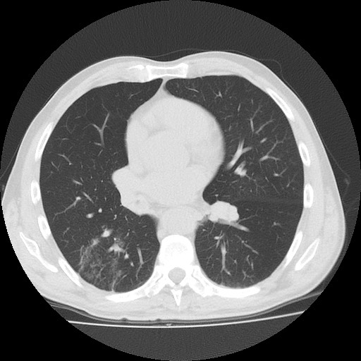 Allergic bronchopulmonary aspergillosis (ABPA) (Radiopaedia 60594-68313 Axial lung window 33).jpg