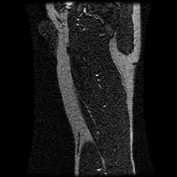 Alveolar soft part sarcoma (Radiopaedia 64501-73678 D 37).jpg