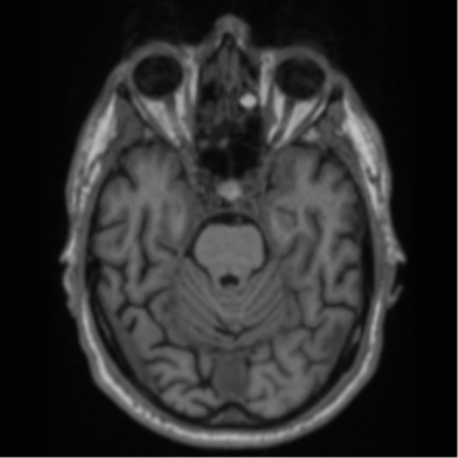 Alzheimer's disease- with Gerstmann syndrome and dressing apraxia (Radiopaedia 54882-61150 Axial T1 24).png
