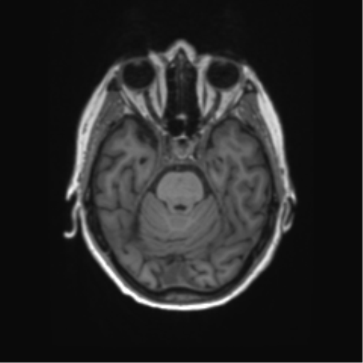 File:Alzheimer's disease (Radiopaedia 42658-45802 Axial T1 105).png