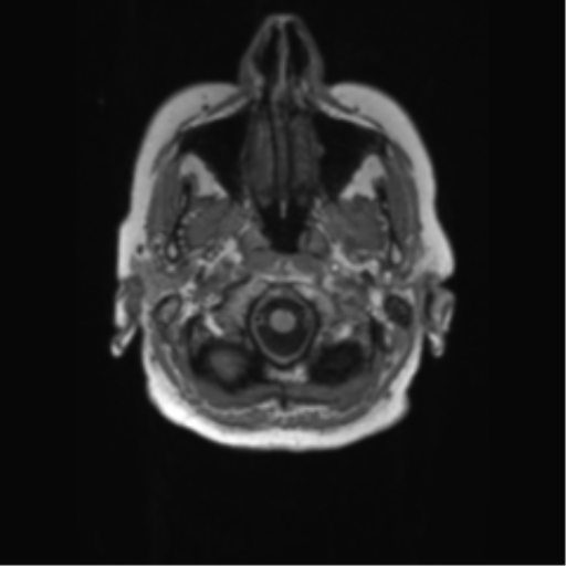 File:Alzheimer's disease (Radiopaedia 42658-45802 Axial T1 141).png