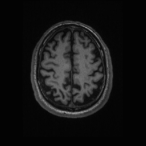 Alzheimer disease - probable (Radiopaedia 35334-36837 Axial T1 57).png