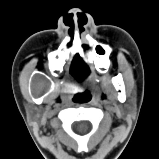 File:Ameloblastoma (Radiopaedia 26645-26793 Axial C+ delayed 25).jpg