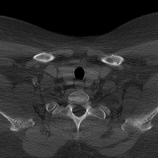 Ameloblastoma (Radiopaedia 38520-40623 Axial bone window 68).png