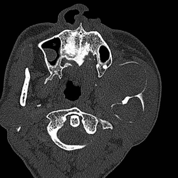 Ameloblastoma (Radiopaedia 51921-57766 Axial bone window 109).jpg