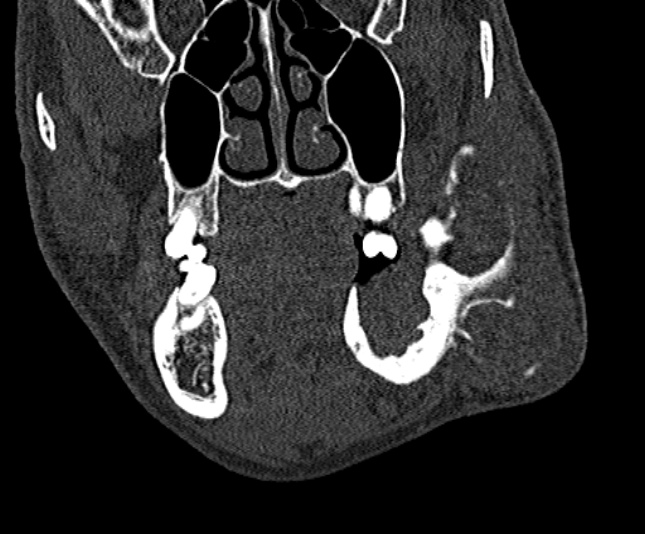 Ameloblastoma (Radiopaedia 51921-57766 Coronal bone window 93).jpg