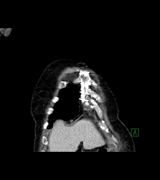 Amiodarone deposition in the liver (Radiopaedia 77587-89780 Coronal non-contrast 14).jpg