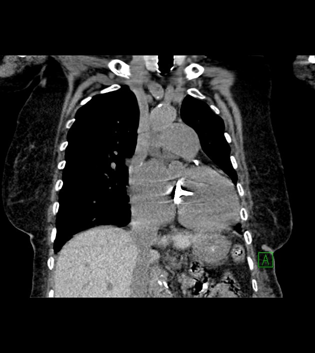 Amiodarone deposition in the liver (Radiopaedia 77587-89780 Coronal non-contrast 34).jpg