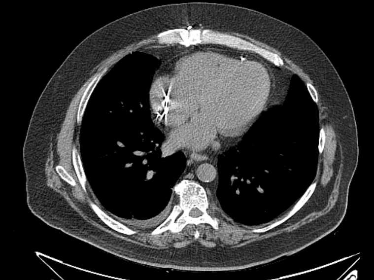 Amiodarone lung (Radiopaedia 62514-70769 Axial non-contrast 59).jpg