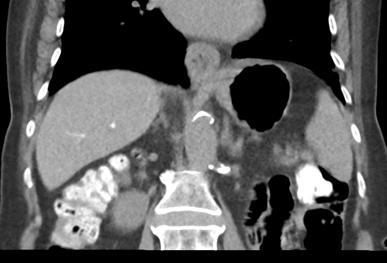 Ampullary adenocarcinoma (Radiopaedia 34013-35241 Coronal 29).png