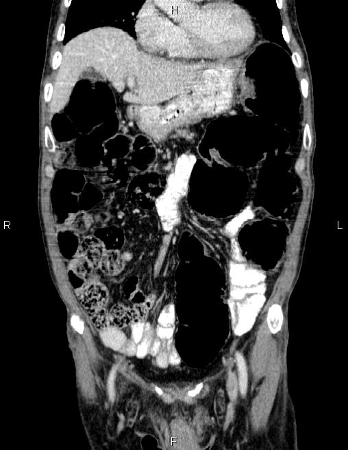 Ampullary adenocarcinoma (Radiopaedia 86093-102032 C 21).jpg