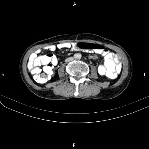 Ampullary adenocarcinoma (Radiopaedia 86093-102033 B 77).jpg