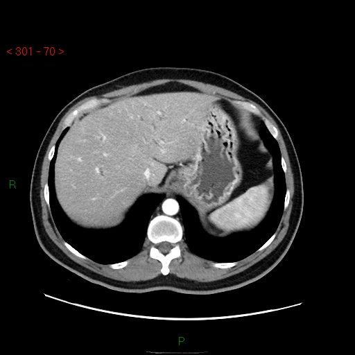 Ampullary carcinoma (Radiopaedia 56396-63056 B 16).jpg