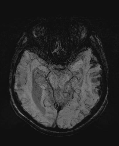 File:Amyloid angiopathy with inflammation (Radiopaedia 30360-31002 Axial SWI MIP 17).jpg