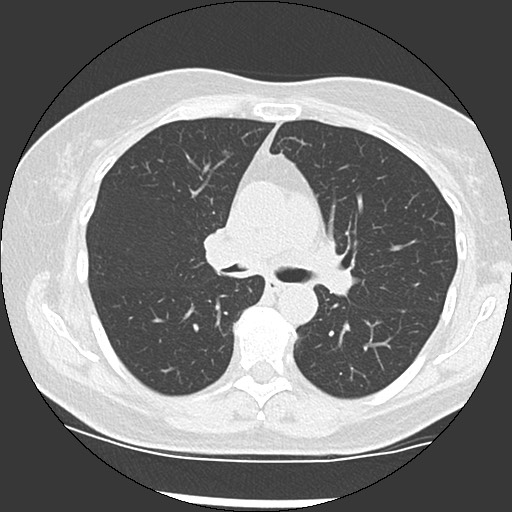 Amyloidosis - bronchial and diffuse nodular pulmonary involvement (Radiopaedia 60156-67744 B 25).jpg