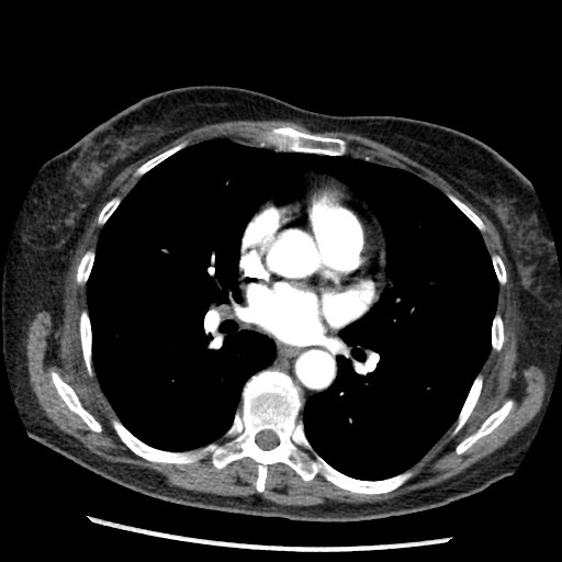 Amyloidosis - bronchial and diffuse nodular pulmonary involvement (Radiopaedia 60156-67745 A 28).jpg