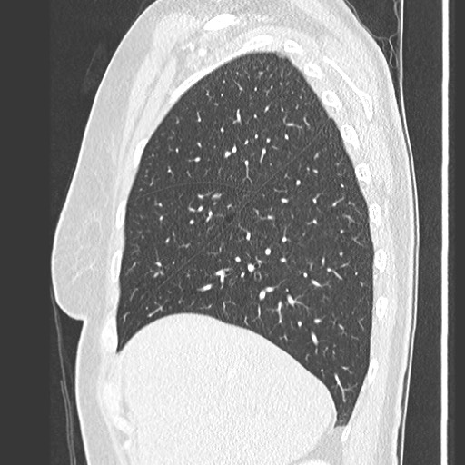 Amyloidosis - bronchial and diffuse nodular pulmonary involvement (Radiopaedia 60156-67745 Sagittal lung window 20).jpg