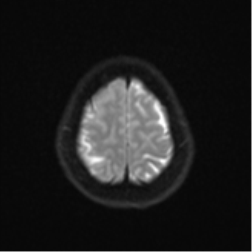 Anaplastic astroblastoma (Radiopaedia 55666-62194 Axial DWI 25).png
