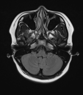 File:Anaplastic astroblastoma (Radiopaedia 55666-62194 Axial FLAIR 6).png
