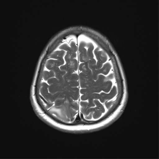 File:Anaplastic astrocytoma (Radiopaedia 86943-103160 Axial T2 31).png