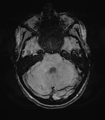 File:Anaplastic astrocytoma IDH mutant (Radiopaedia 50046-55341 Axial SWI 26).png