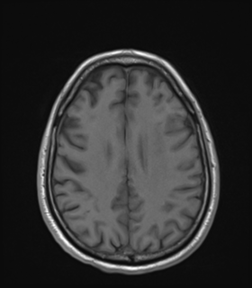 Anaplastic astrocytoma IDH wild-type (Radiopaedia 49984-55273 Axial T1 40).png