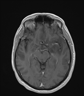 Anaplastic astrocytoma IDH wild-type (Radiopaedia 49984-55273 Axial T1 C+ 26).png