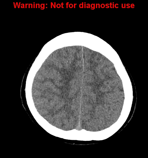 File:Anaplastic ganglioglioma (Radiopaedia 44921-48815 Axial non-contrast 22).jpg