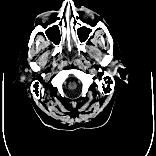 File:Anaplastic meningioma with recurrence (Radiopaedia 34452-35781 Axial non-contrast 2).png
