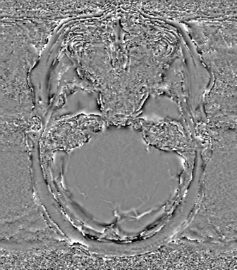 Anaplastic oligodendroglioma (Radiopaedia 83500-98599 Axial SWI - phase 21).png