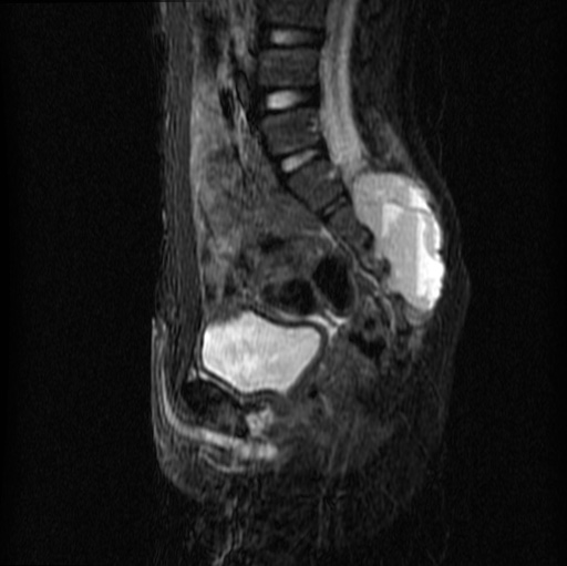 File:Aneurysmal bone cyst - sacrum (Radiopaedia 65190-74196 Sagittal STIR 16).jpg