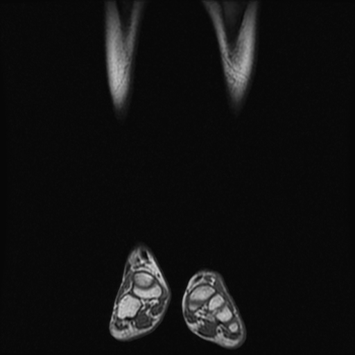 File:Aneurysmal bone cyst - tibia (Radiopaedia 22343-22367 Coronal T1 2).jpg