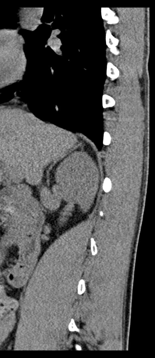 Aneurysmal bone cyst T11 (Radiopaedia 29294-29721 E 64).jpg