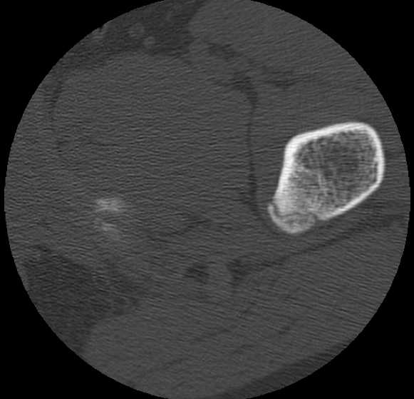 Aneurysmal bone cyst of ischium (Radiopaedia 25957-26094 B 55).png