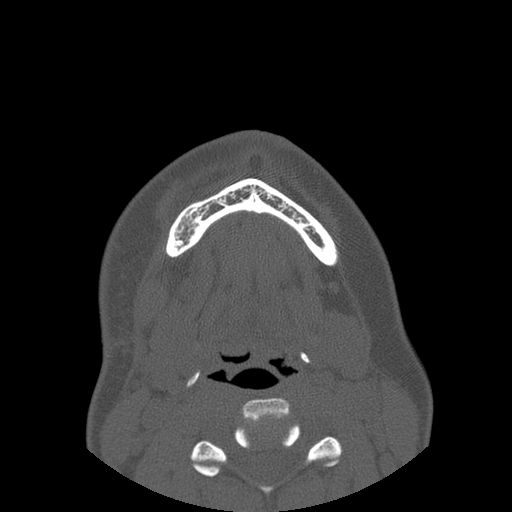 Aneurysmal bone cyst of the mandible (Radiopaedia 43280-46823 Axial bone window 22).jpg
