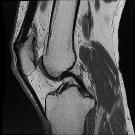 Anomalous insertion of the medial meniscus (Radiopaedia 77559-89721 Sagittal PD 29).jpg